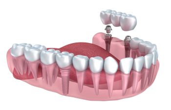 A 3d model of a implant-supported dental bridge