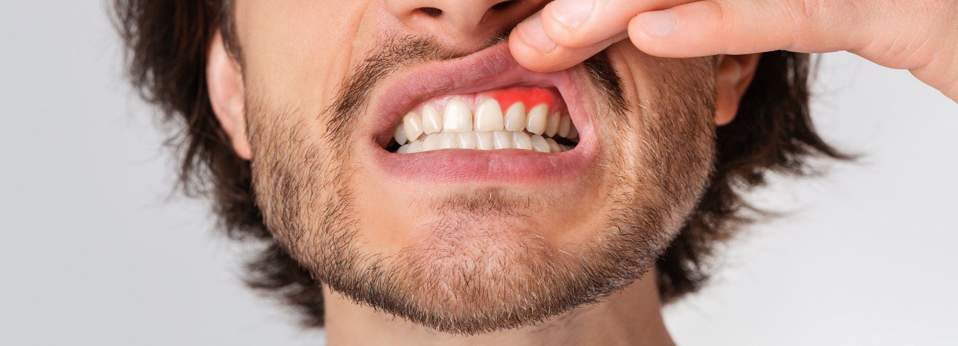 A man showing his red swollen gum.